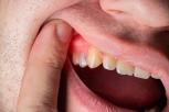 Abses Periodontal Penyebab, Gejala, Pengobatan, dan Pencegahan